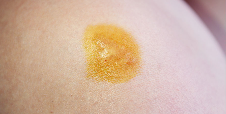 Skin Test with Iodine Skin Test with Iodine